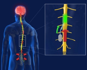 Spinal implant image