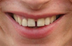 gap-teeth.jpg