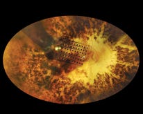 Netzhautimplantate: Wie die drahtlose Technologie im Auge blinden Menschen das Sehvermögen zurückgibt
