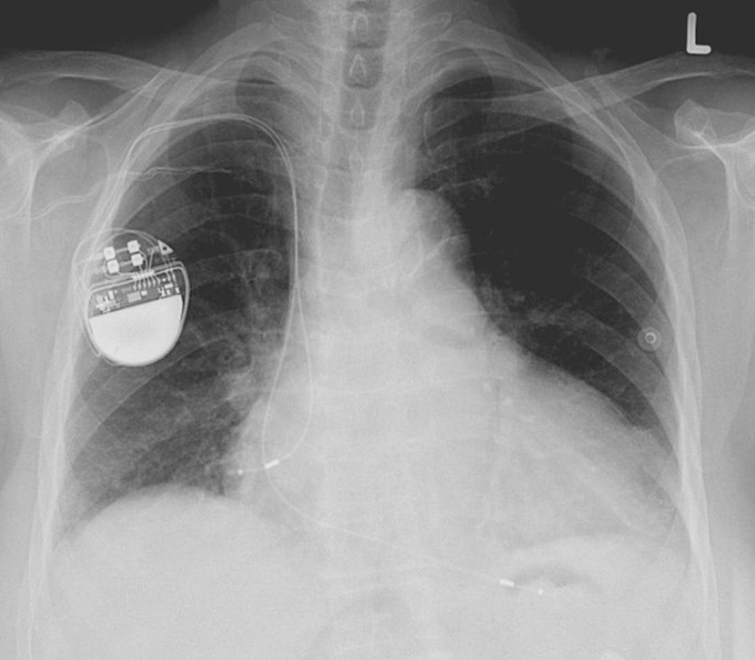 it-life-pacemaker-lucien-monfiles.jpg