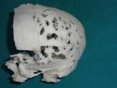 Indian surgeons tackle rare disease with 3D-printed skull