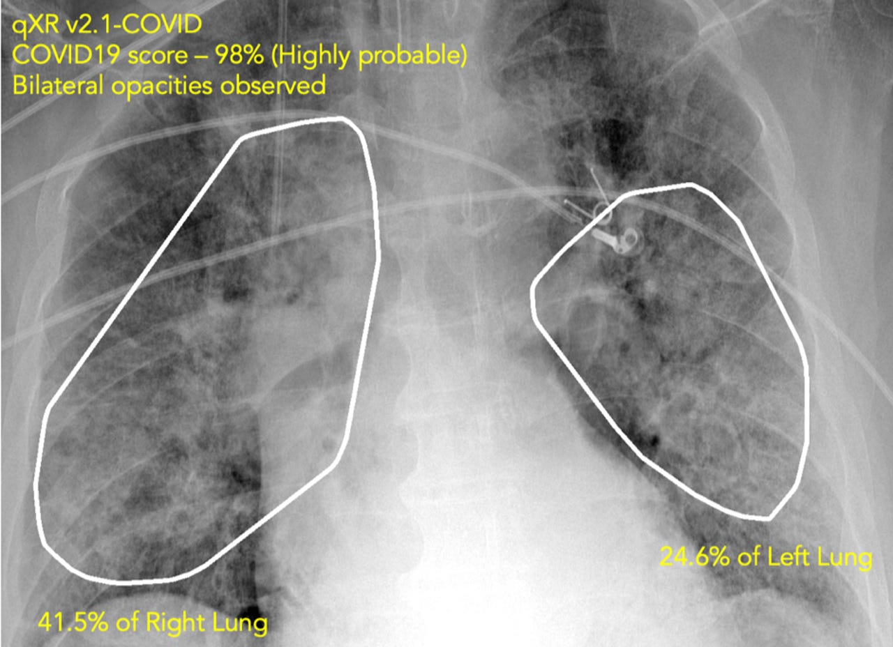 qure-ai-covid-19-lung-xray-april-2020.png