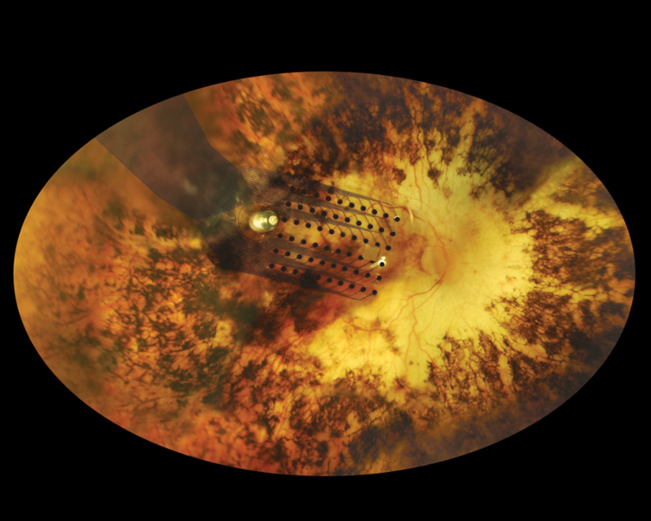 fundus-retinal-implantsecond-sight.jpg
