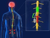 Sydney scientists beat pain with spinal chip